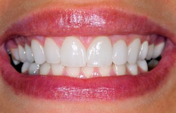 🥇 Teeth Straightening Treatment - Atlanta, GA