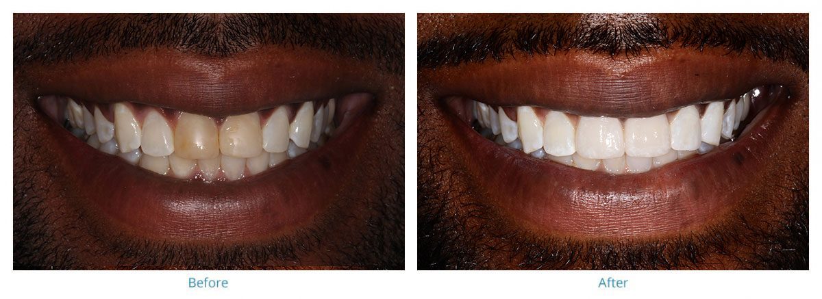 🥇 Feather Touch Dental Care Before and After Gallery